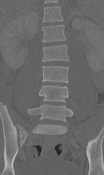 File:Chance fracture (Radiopaedia 40360-42912 Coronal bone window 28).png