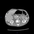 Chance fracture with duodenal and pancreatic lacerations (Radiopaedia 43477-46864 A 10).jpg