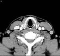 Chondrosarcoma - larynx (Radiopaedia 4588-6698 A 8).jpg