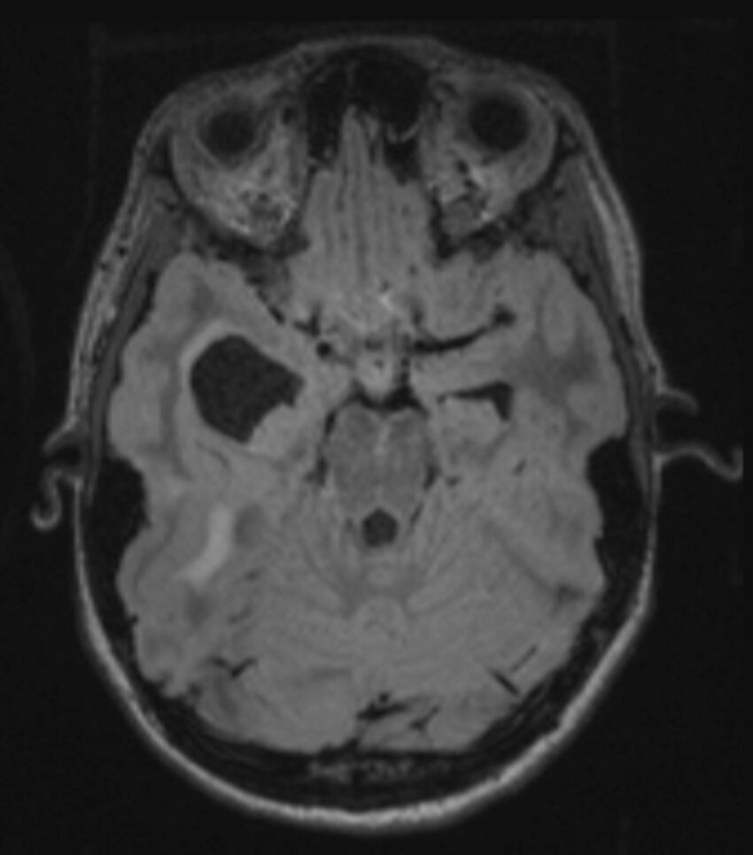 Choroid plexus carcinoma (Radiopaedia 91013-108553 Axial FLAIR C+ 109).jpg