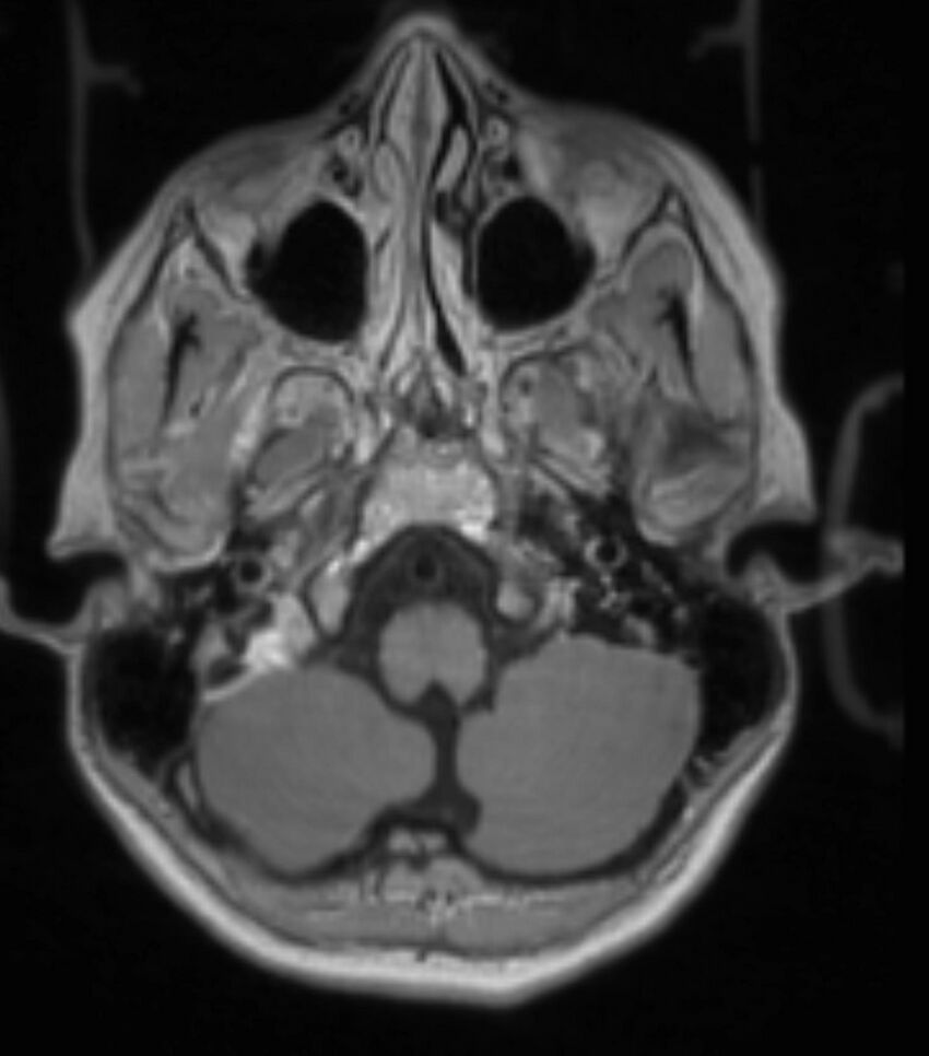 Choroid plexus carcinoma (Radiopaedia 91013-108553 Axial T1 C+ 86).jpg