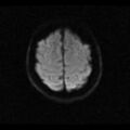 Choroid plexus xanthogranuloma (Radiopaedia 17650-17386 DWI 4).jpg