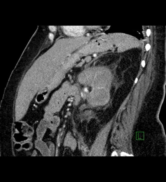 File:Chromophobe renal cell carcinoma (Radiopaedia 84239-99519 D 47).jpg