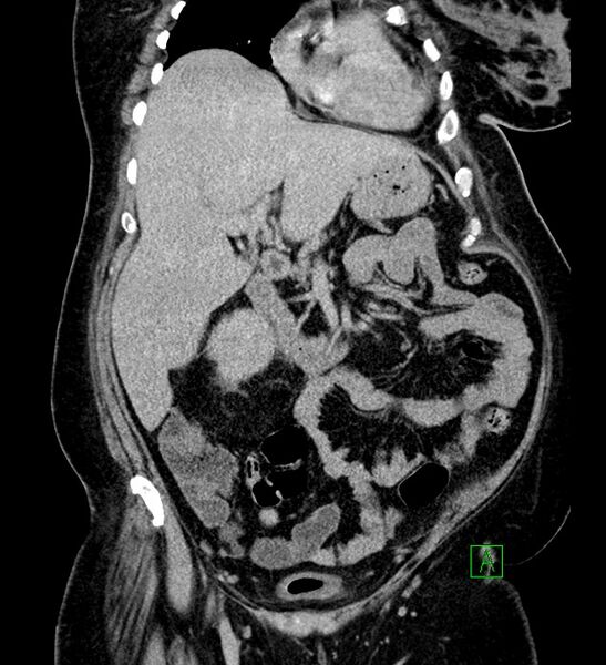 File:Chromophobe renal cell carcinoma (Radiopaedia 84239-99519 F 35).jpg