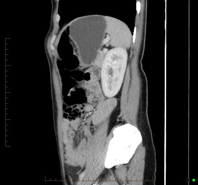 File:Chronic abscess due to "dropped" appendicoliths following appendectomy for perforated appendix (Radiopaedia 58805-66344 D 15).jpg