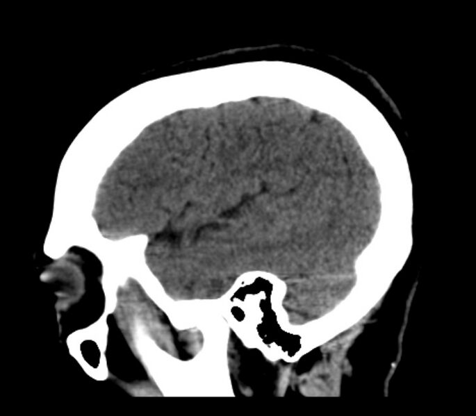 File:Chronic bilateral occipital lobe infarcts (Radiopaedia 31276-31996 C 10).jpg