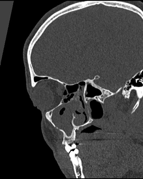 File:Chronic maxillary sinusitis caused by a foreign body (Radiopaedia 58521-65676 Sagittal bone window 14).jpg