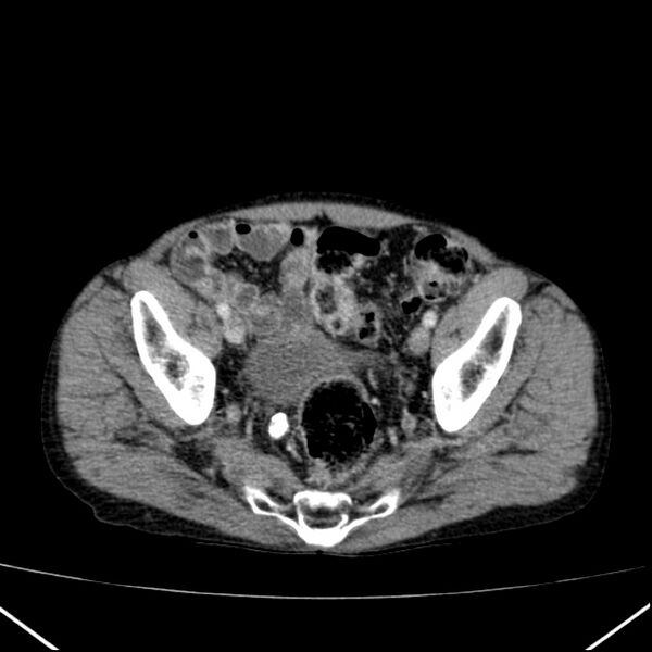 File:Chronic pancreatitis (Radiopaedia 23132-23172 B 61).jpg