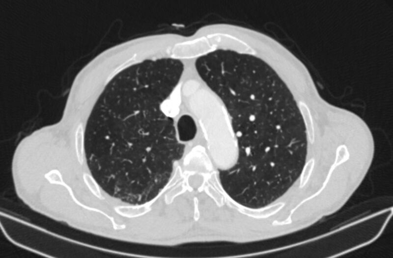 File:Chronic pulmonary embolism (Radiopaedia 91241-108843 Axial lung window 23).jpg