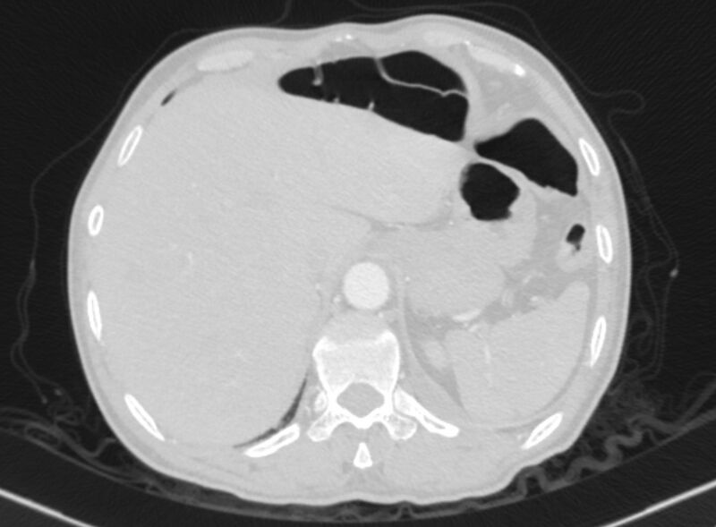 File:Chronic pulmonary embolism with bubbly consolidation (Radiopaedia 91248-108850 Axial lung window 144).jpg