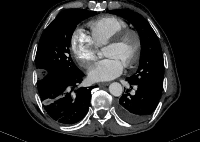 File:Chronic pulmonary embolism with bubbly consolidation (Radiopaedia 91248-108850 C+ arterial phase 97).jpg