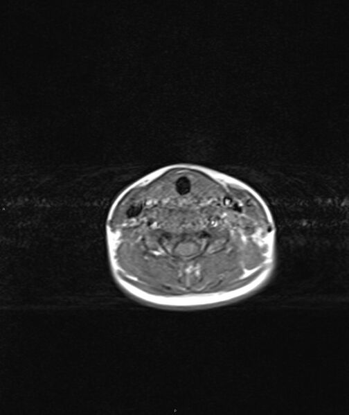 File:Chronic reactive multifocal osteomyelitis (CRMO) - mandible (Radiopaedia 56405-63069 Axial T1 1).jpg