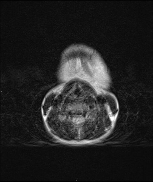 File:Chronic reactive multifocal osteomyelitis (CRMO) - mandible (Radiopaedia 56405-63069 Axial T2 3).jpg