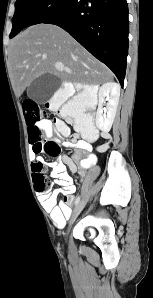 File:Chronic small bowel volvulus (Radiopaedia 75224-86322 C 100).jpg