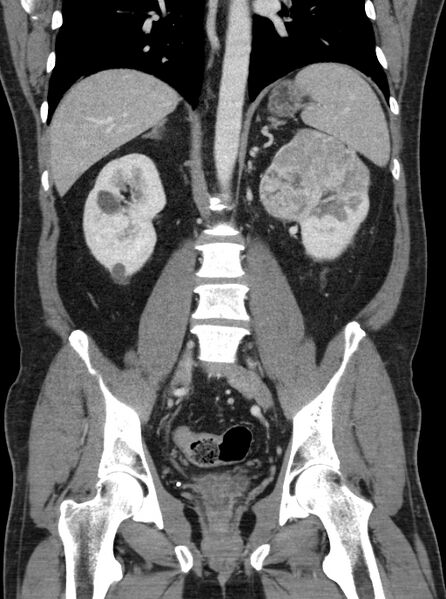 File:Clear cell renal cell carcinoma (Radiopaedia 61449-69393 F 29).jpg