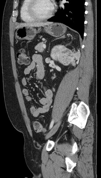 File:Clear cell renal cell carcinoma (Radiopaedia 61449-69393 G 36).jpg
