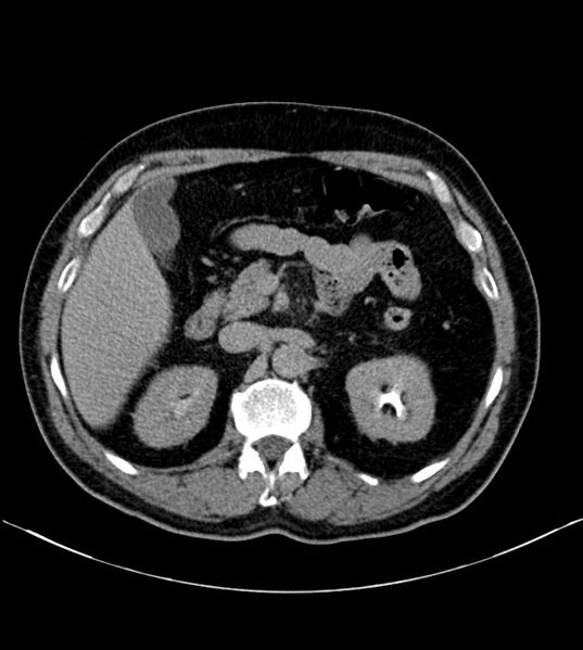 File:Clear cell renal cell carcinoma (Radiopaedia 85006-100539 H 10).jpg