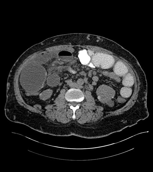 File:Closed-loop small bowel obstruction-internal hernia (Radiopaedia 78439-91096 Axial non-contrast 78).jpg