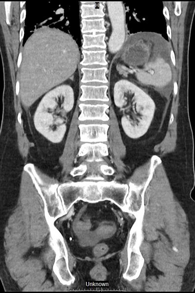 File:Closed loop bowel obstruction and ischemia (Radiopaedia 86959-103180 B 31).jpg