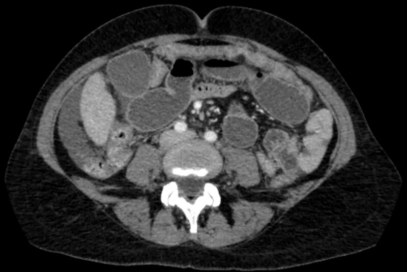 File:Closed loop small bowel obstruction (Radiopaedia 71211-81508 A 74).jpg