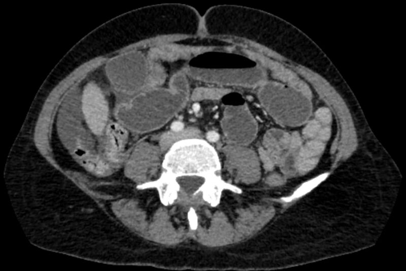 File:Closed loop small bowel obstruction (Radiopaedia 71211-81508 A 77).jpg