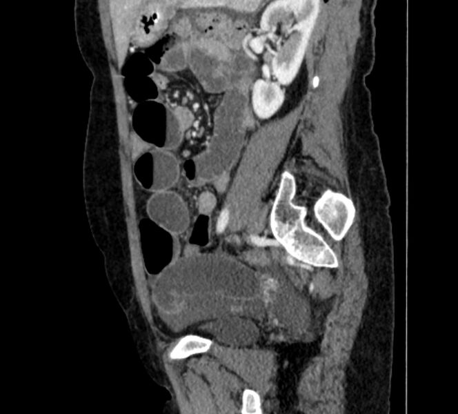 File:Closed loop small bowel obstruction (Radiopaedia 71211-81508 C 107).jpg