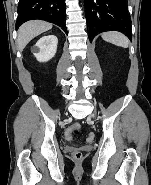 File:Closed loop small bowel obstruction - internal hernia (Radiopaedia 57806-64778 A 84).jpg