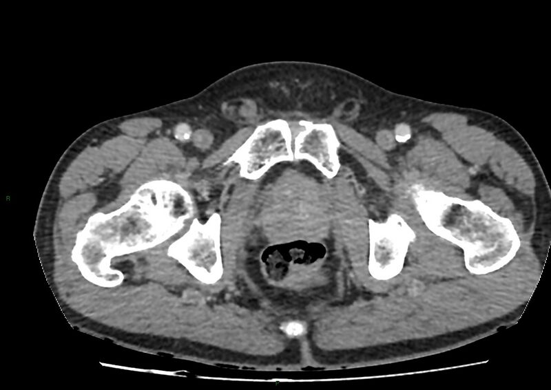 File:Closed loop small bowel obstruction with ischemia (Radiopaedia 84180-99456 A 120).jpg