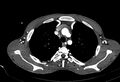 Coarctation of aorta with aortic valve stenosis (Radiopaedia 70463-80574 A 25).jpg