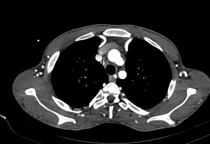 File:Coarctation of aorta with aortic valve stenosis (Radiopaedia 70463-80574 A 25).jpg