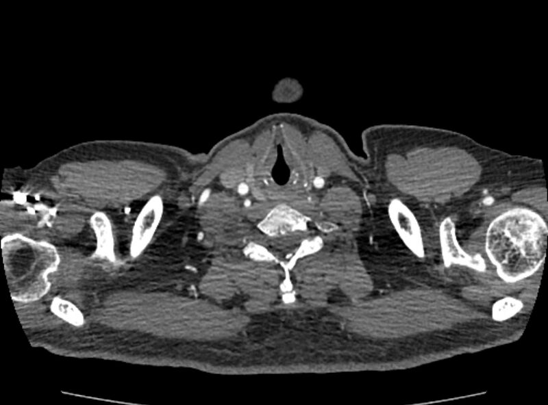 File:Coarctation of the aorta (Radiopaedia 53363-59343 A 4).jpg
