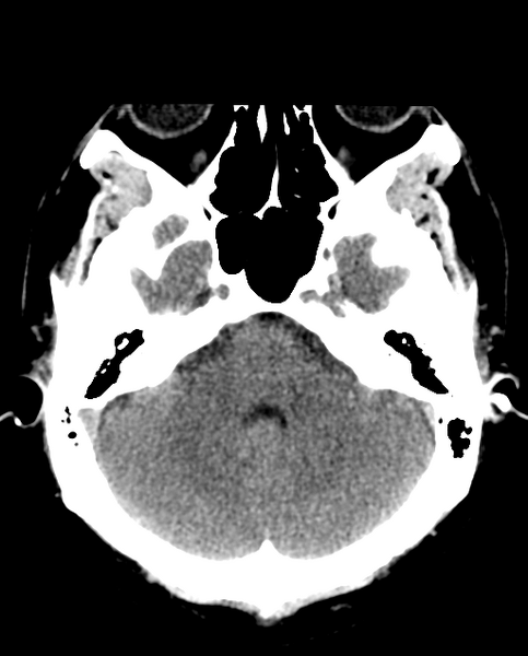 File:Colloid cyst of the third ventricle (Radiopaedia 86571-102661 Axial non-contrast 10).png