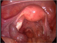 Ectopic molar pregnancy - laparoscopy