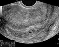 First trimester oligohydramnios (Radiopaedia 9791).jpg