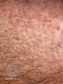 Lichen amyloidosis (DermNet NZ lichen-amyloidosis-06).jpg