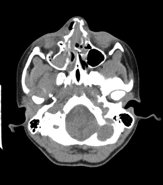 File:Nasoorbitoethmoid fracture (Radiopaedia 90044-107205 Axial non-contrast 140).jpg