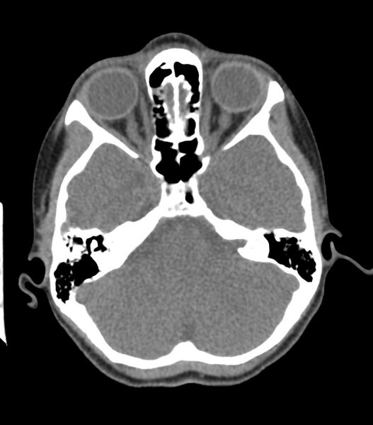 File:Nasoorbitoethmoid fracture (Radiopaedia 90044-107205 Axial non-contrast 164).jpg