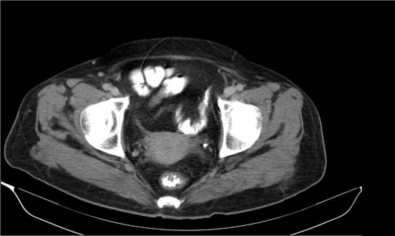 File:Necrotizing pancreatitis (Radiopaedia 20595-20495 Axial C+ delayed 43).jpg