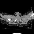 Neonatal neuroblastoma (Radiopaedia 56651-63438 Axial non-contrast 86).jpg