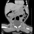 Neonatal neuroblastoma (Radiopaedia 56651-63438 Coronal non-contrast 22).jpg