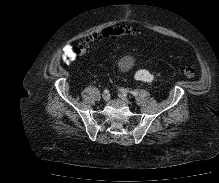 Nephroptosis with inguinal hernia containing perirenal fat (Radiopaedia 56632-63391 C 255).jpg