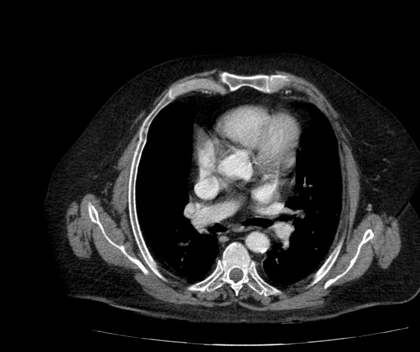 Nephroptosis with inguinal hernia containing perirenal fat (Radiopaedia 56632-63391 C 7).jpg