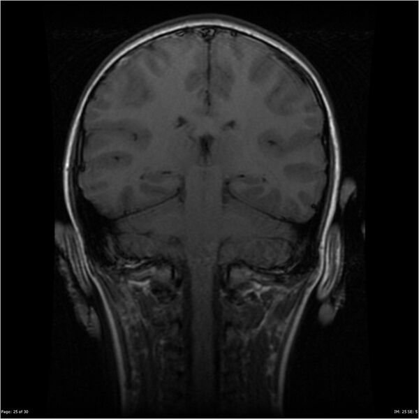 File:Neurofibromatosis type 1 (Radiopaedia 22541-22564 Coronal T1 34).jpg