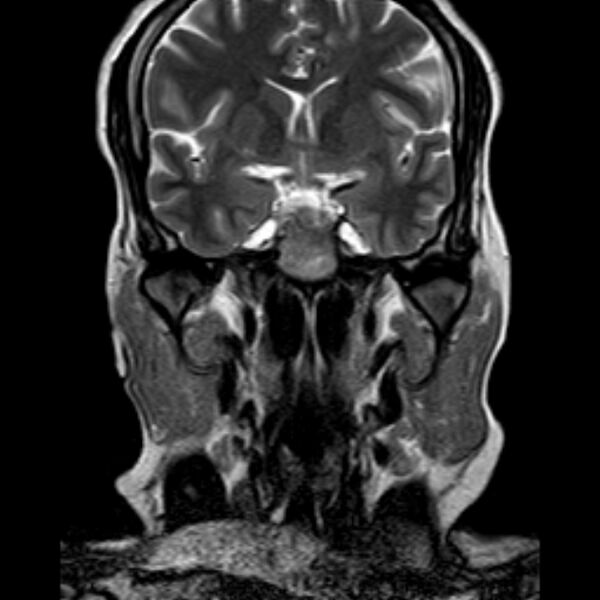 File:Neurofibromatosis type 2 (Radiopaedia 67470-76871 Coronal T2 7).jpg