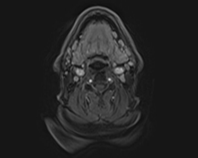 File:Non-Hodgkin lymphoma - parotid gland (Radiopaedia 71531-81890 E 3).jpg