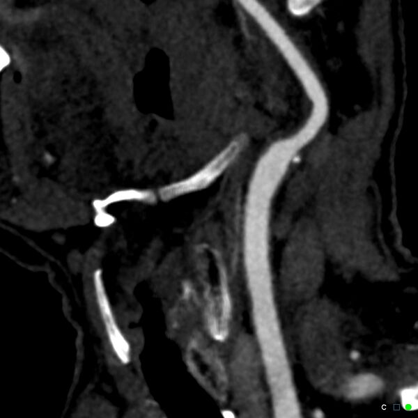 File:Non-occlusive intraluminal internal carotid artery thrombus (Radiopaedia 37751-39658 C 65).jpg