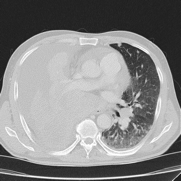 File:Non small-cell lung cancer (Radiopaedia 24467-24769 lung window 25).jpg
