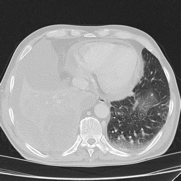 File:Non small-cell lung cancer (Radiopaedia 24467-24769 lung window 41).jpg