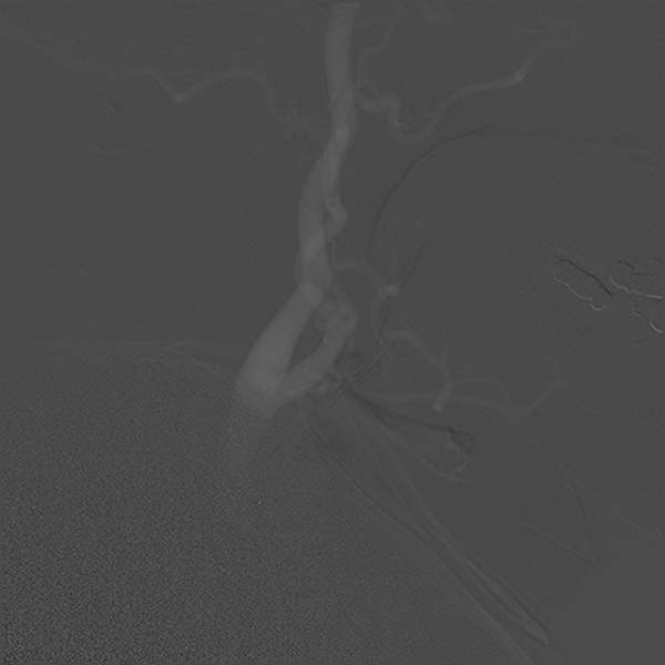 File:Normal cerebral angiogram (four vessel DSA) (Radiopaedia 41708-44649 C 7).png