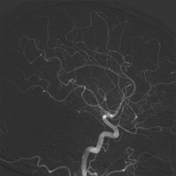 File:Normal cerebral angiogram (four vessel DSA) (Radiopaedia 41708-44649 F 9).png